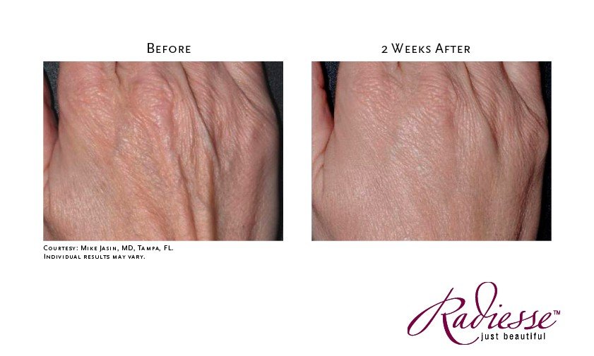 Treatment of Hands with Radiesse